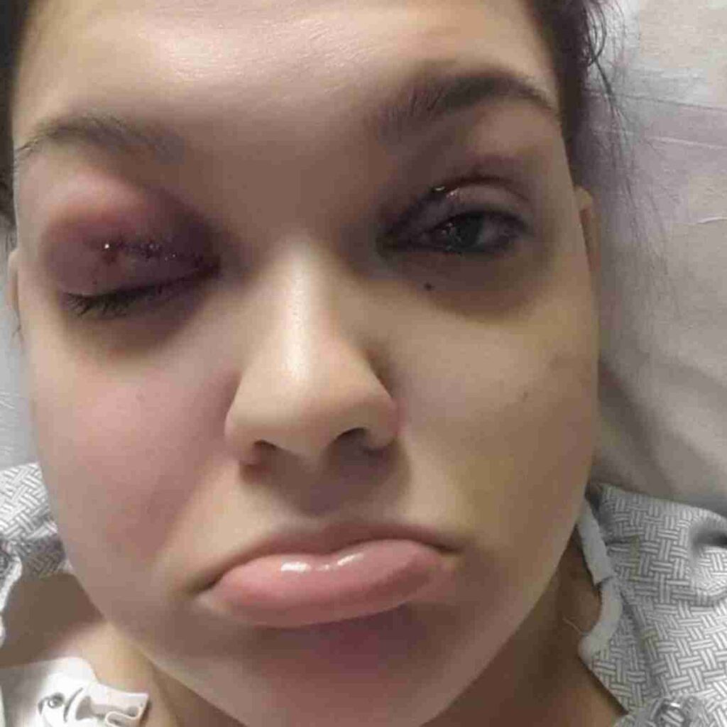 Photo of Melissa after IIH diagnosis