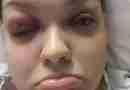 Photo of Melissa after IIH diagnosis