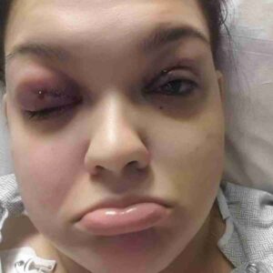 Photo of Melissa after IIH diagnosis