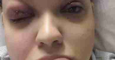Photo of Melissa after IIH diagnosis