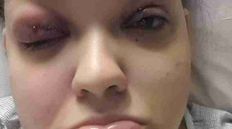 Photo of Melissa after IIH diagnosis