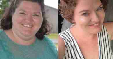 Danielle before and after her weight loss surgery in Mexico