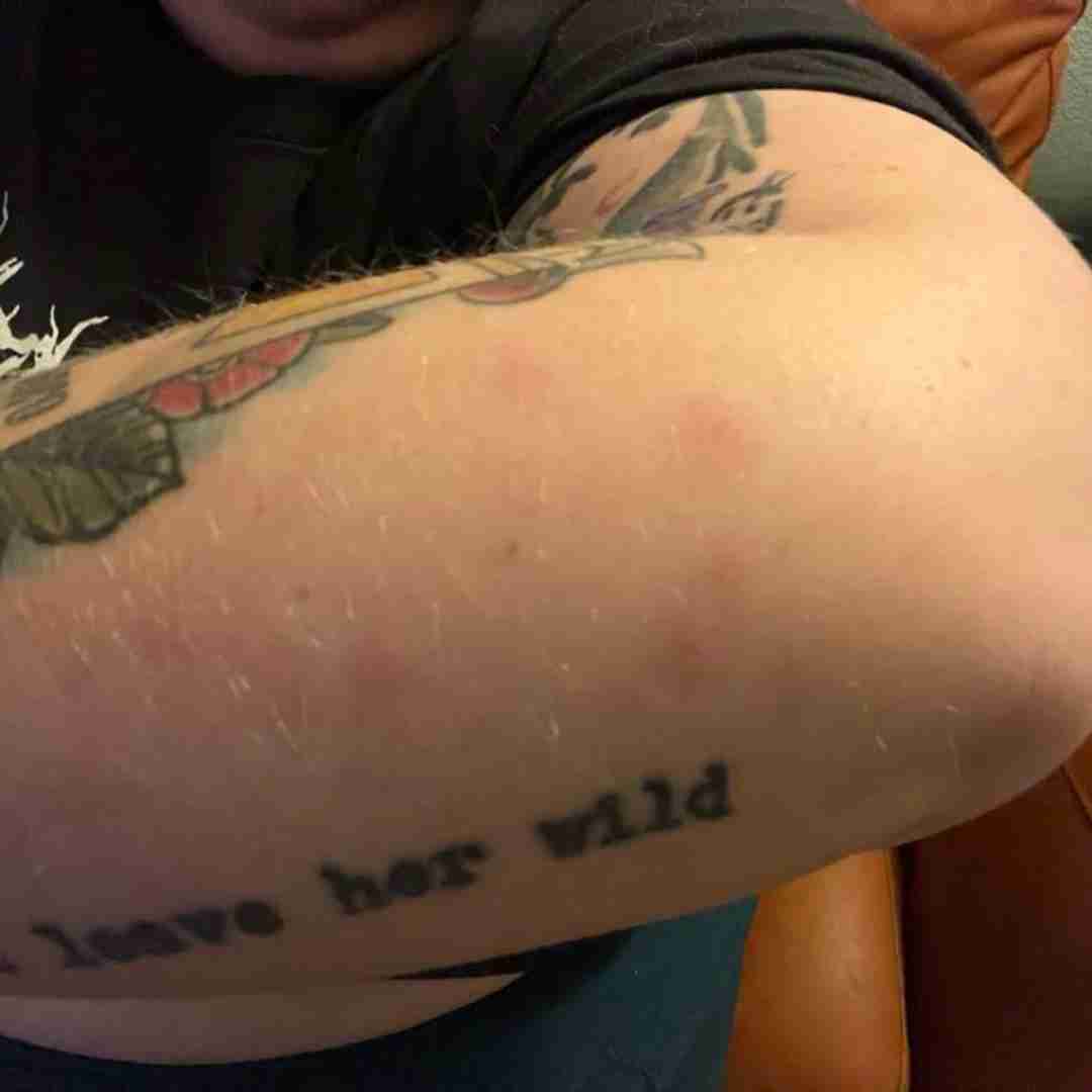 Photo of Keri's arm with rash.