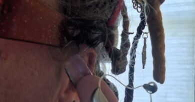 A photo of the author showing how the device to treat her impaired hearing gets stuck in her hair.
