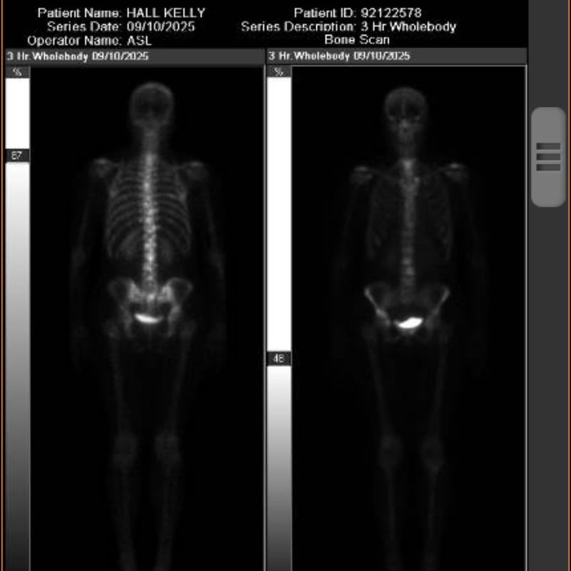 Imaging from Kelly Hall's medical scans when her cancer came back and she began redefining health.