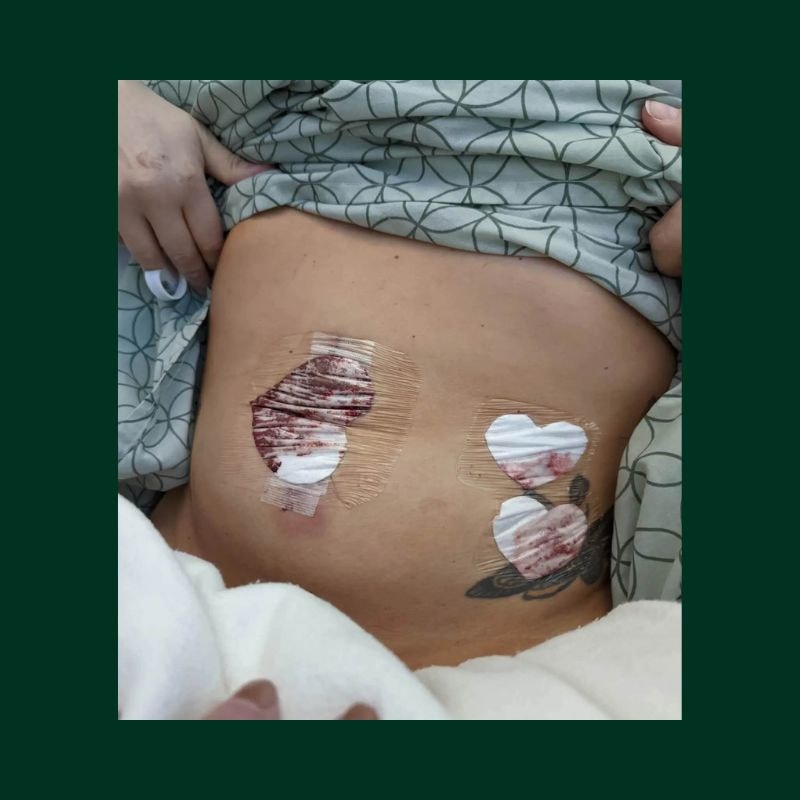 Life With Kidney Disease: This Is Living—Even Now 3 Kidney removal surgery, called nephrectomy, is typically a laparoscopic procedure. Tiffini had her overgrown left kidney removed in 2023.